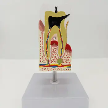 Анатомическая модел на болните зъби на човека, медицинската анатомия за обучение на пациенти